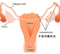 子宫内膜异位